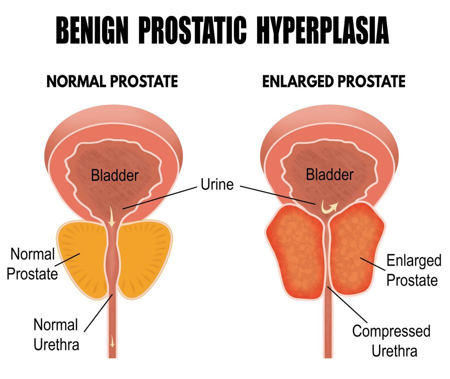 Diagrams of a normal prostate and enlarged prostate.
