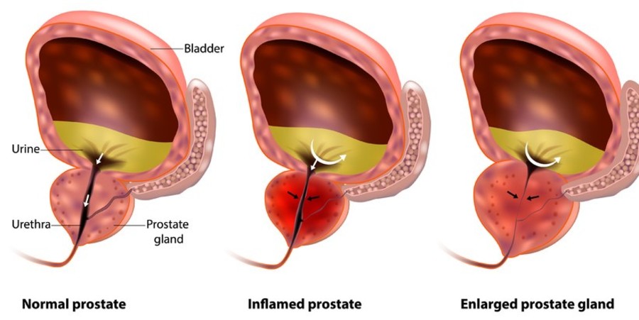 Normal prostate, inflamed prostate and enlarged prostate gland.