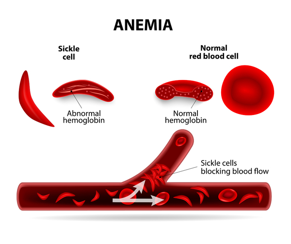 Men with Sickle Cell Disease Should Educate Themselves About ED