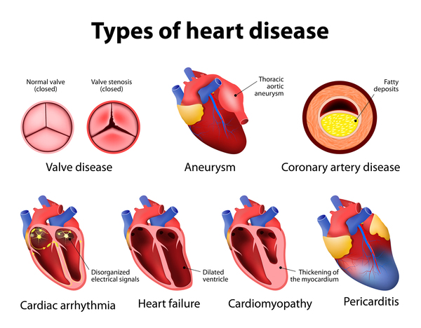 Q&A: I Have Cardiac Disease but Don’t Take Nitrates. Can I Take Viagra ...