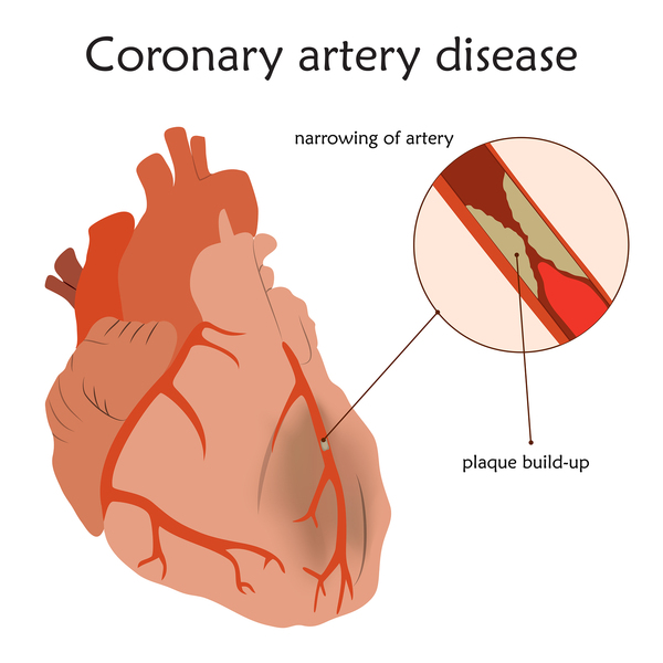 can viagra cause heart disease