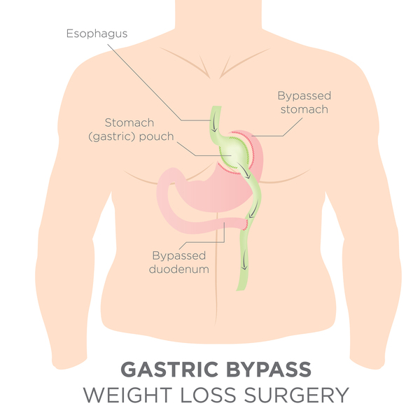 Can Gastric Bypass Surgery Help with Male Impotence Online