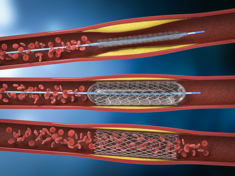 Endovascular Stenting Effective Treatment for Erectile