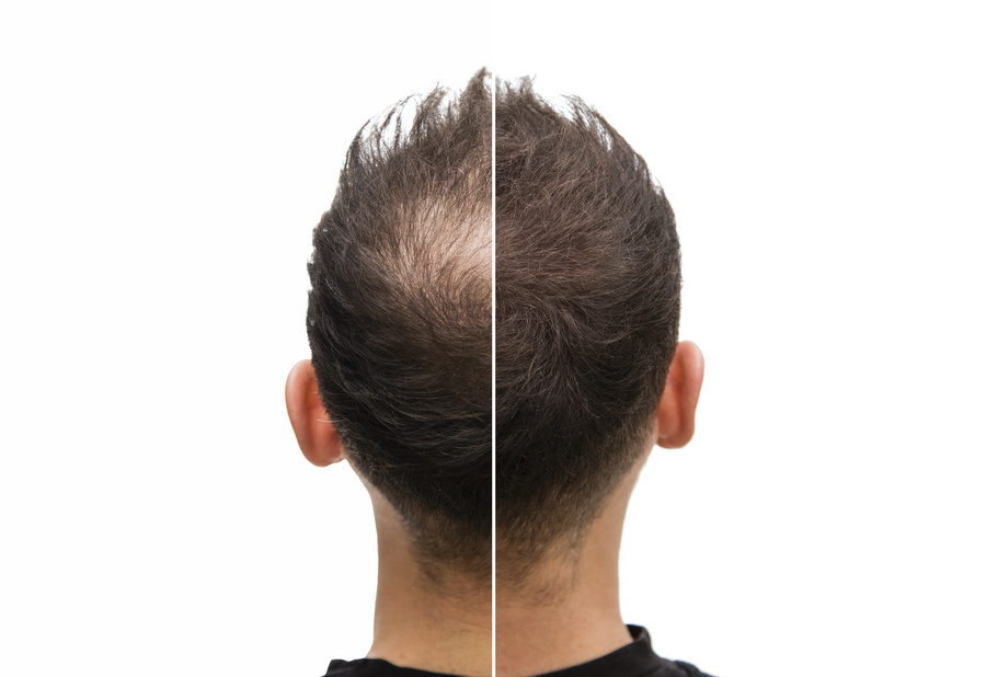 Man before and after hairless treatment.