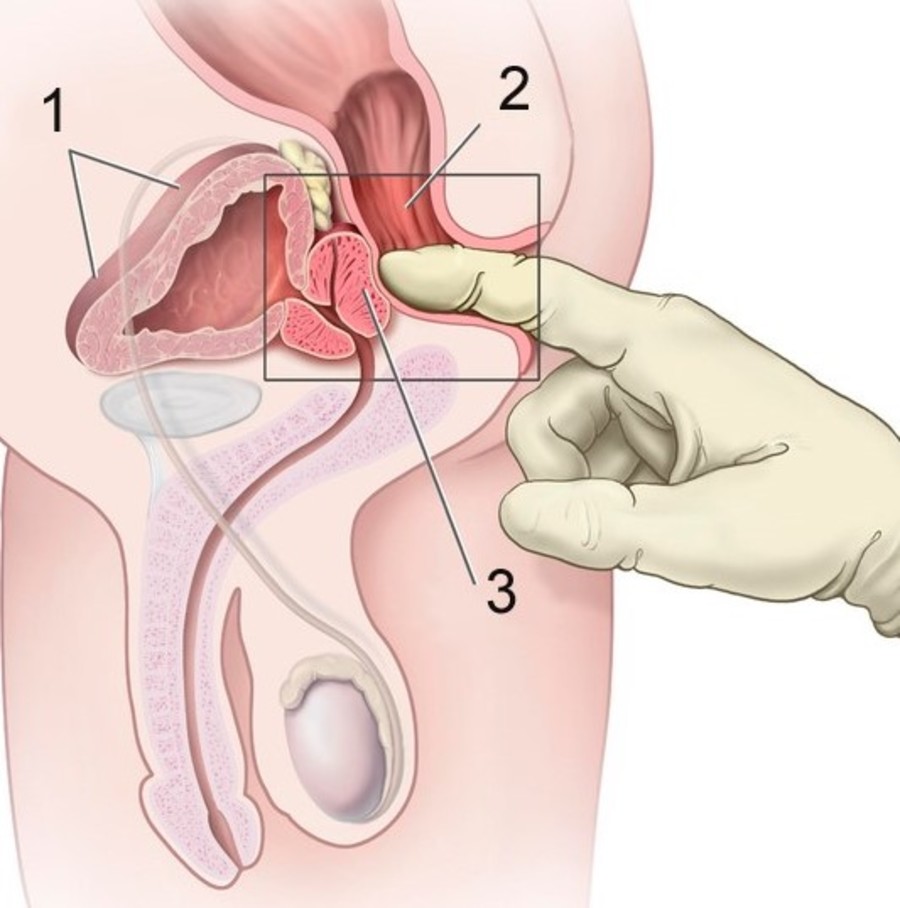 erecron a prostatitis