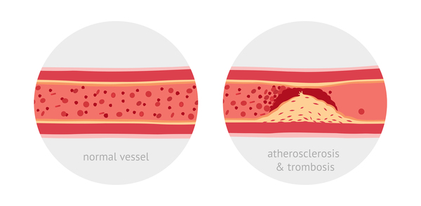 Drawing of a normal vessel and a vessel with atherosclerosis & trombosis