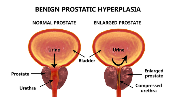 why-cialis-may-be-preferable-if-you-have-prostate-enlargement