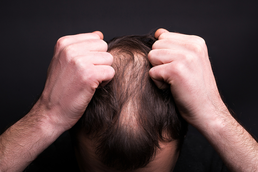 Does finasteride stophaltreverse hair loss if taken correctly and early  on enough or does it simply slow down its progression  Quora