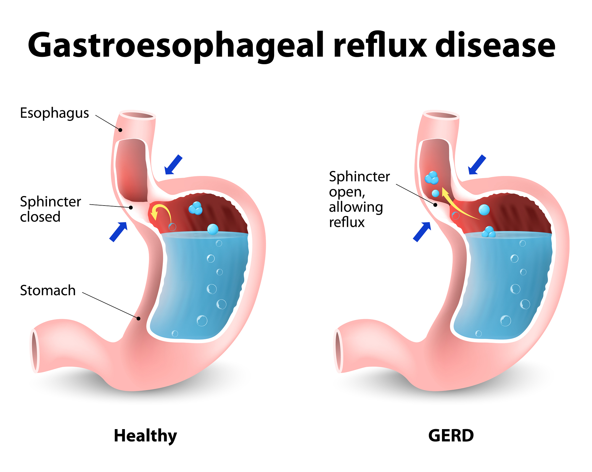 What's Causing Your Heartburn? | Edrugstore.com Blog