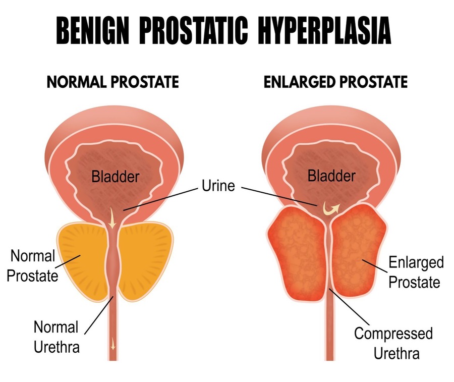 Benign prostatic hyperplasia diagram.