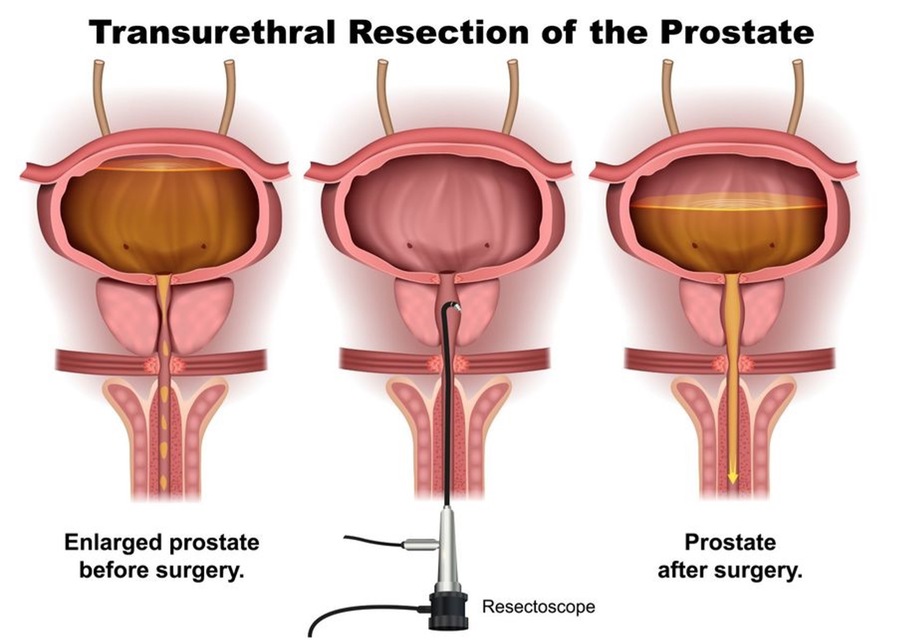 Transurethral resection of the prostate diagram.